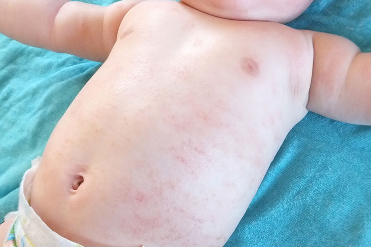 あせも.のイメージ写真